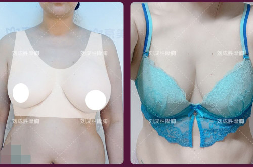 手术或成灾难？丰体针丰胸后的潜在健康危机